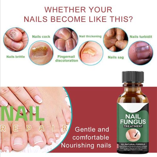 Fast Nail Fungal Treatments Nail Repair Essences Serum Care