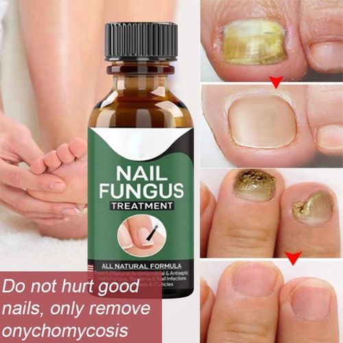 Fast Nail Fungal Treatments Nail Repair Essences Serum Care